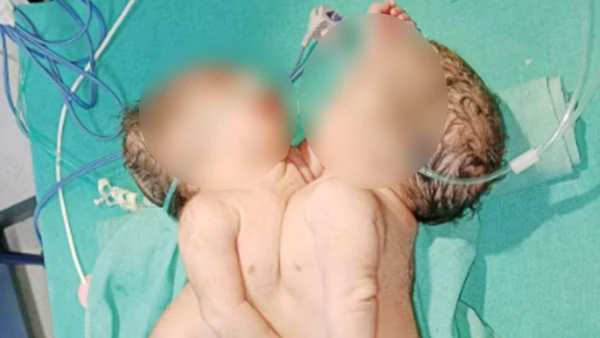 MP: मध्य प्रदेश के बड़वानी में महिला ने दिया जुड़वा बच्चियों को जन्म, दोनों को देखकर स्टाफ हो गया हैरान